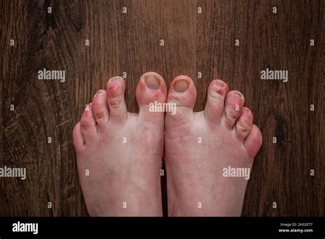 white feet|Raynauds Disease: Feet Pictures,。